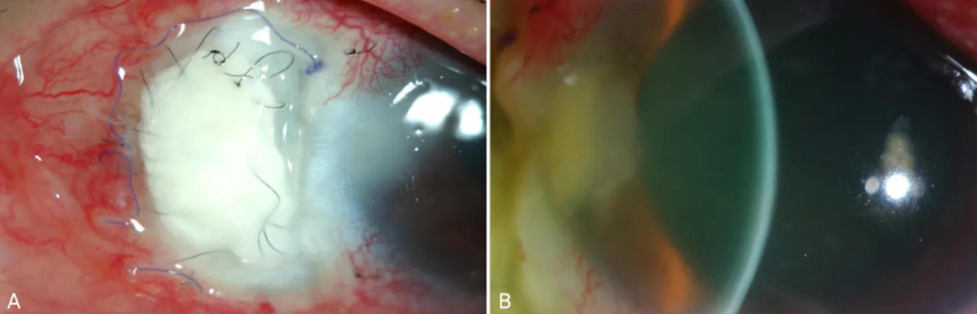 Figure  1. (A)  At  the  diagnosis,  there  was  severe  melting  of  scleral  graft  and  its  surrounding  tissue  with  severe  conjuncitval injection
