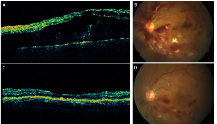 Figure  1. Change  in  retinal  thickness  after  bevacizumab  injection.  A  62-year-old  patient  (No