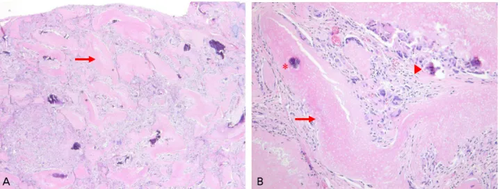 Figure 4. Histologic findings of mass of all cases are consistent with pilomatricoma. Irregular nets of phantom cells  (arrow) with a calcification (asterisk) is shown