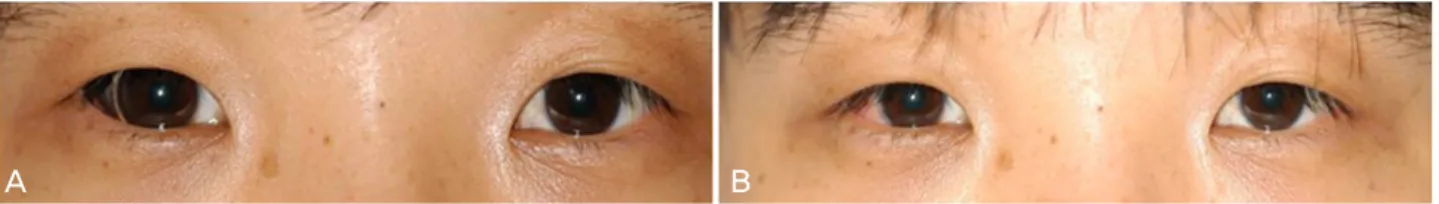 Figure 2. Compared with the preoperative photograph (A) the postoperative photograph (B) showed no noticeable  pigmented  lesion  on  the  front  view.
