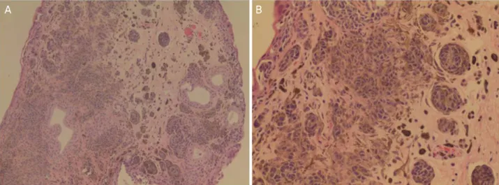 Figure  3. Histopathologic  examinations  showed  that  multiple  nests  of  nevus  cells  and  several  stromal  cysts