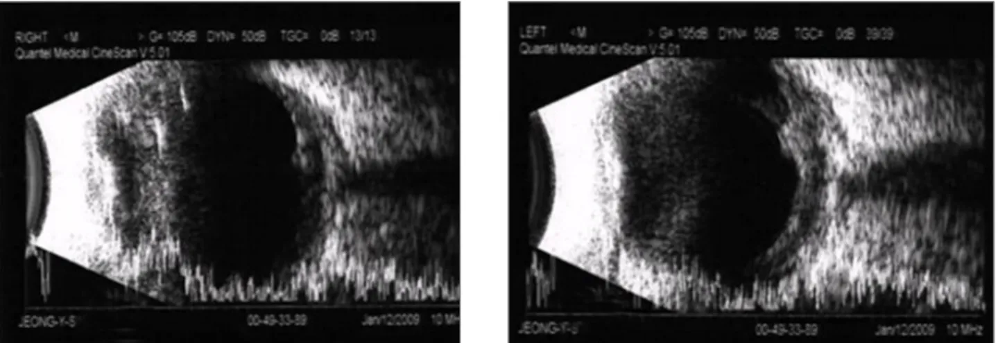 Figure  2. B-scan  finding  at  admission  day.  Retinal  detachment  was  found  in  both  eyes.