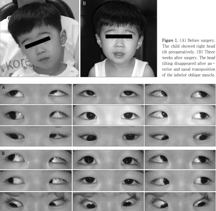 Figure 1. (A) Before surgery.