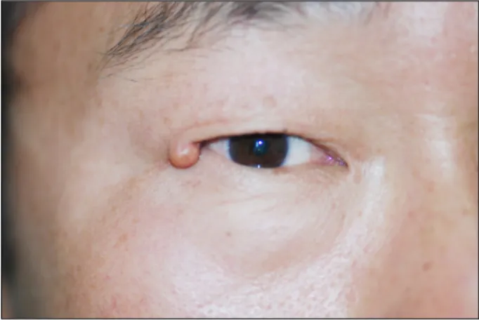 Figure 1. Clinical appearance of the right lateral canthal lesion  at initial presentation shows a cystic and pedunculated nodule.