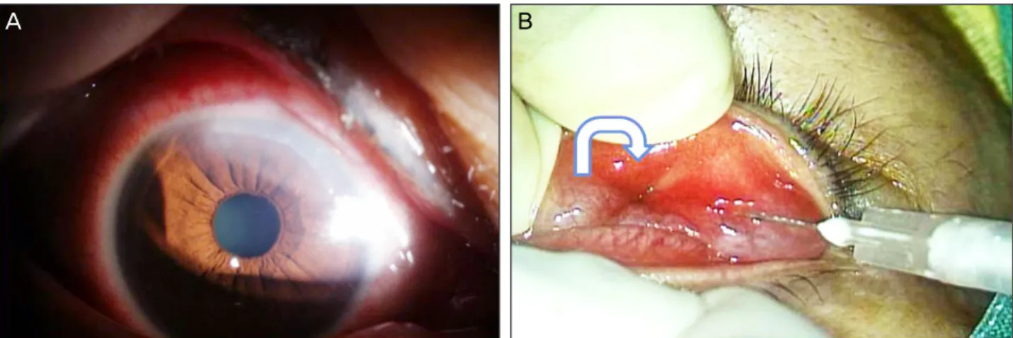 Figure 2. Anterior segment photograph of the cornea near the limbus of the right eye at initial presentation