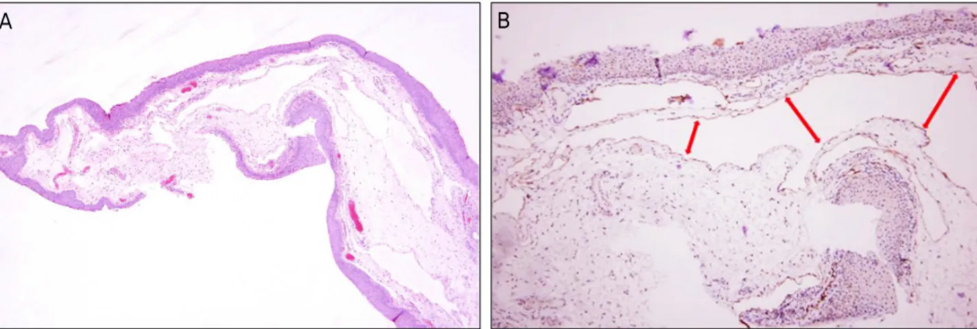 Figure 3. Histopathologic finding of the superior bulbar conjunctiva. (A) Hematoxylin and eosin stain, ×40