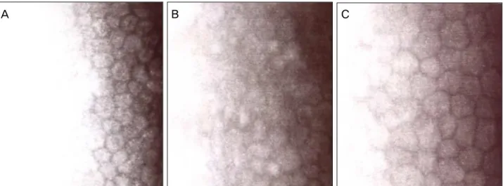 Figure 2. Specular microscopic findings according to timeline. (A) Preoperative specular microscopic findings