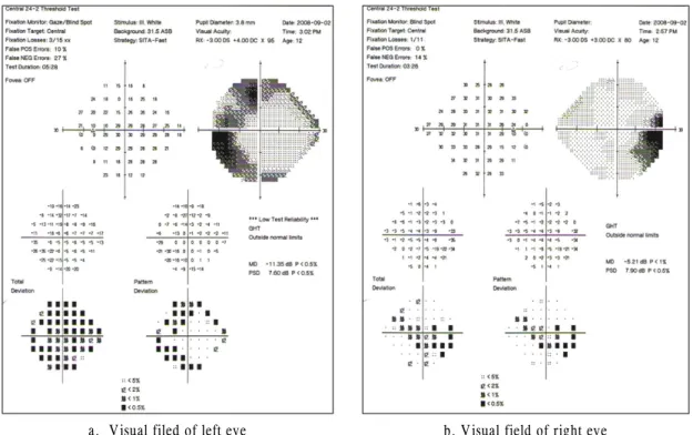 Figure 4. Visual field test (Kinetic and 24-2) shows decreased peripheral visual field of the left eye and increased  physiologic scotoma of the right eye.
