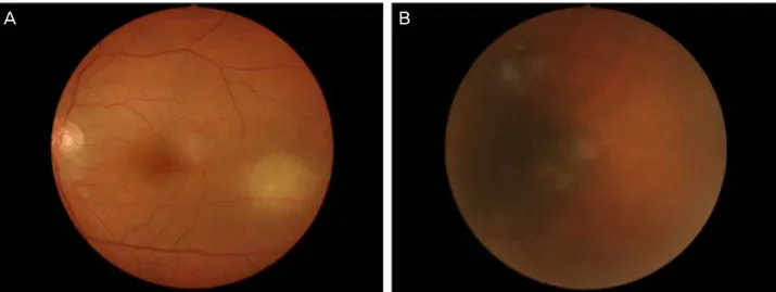 Figure 3. (A) Exudative retinal detachment, retinal hemorrhage, and whitish subretinal lesion are decreased in the fundus photo- photo-graph 7 days later