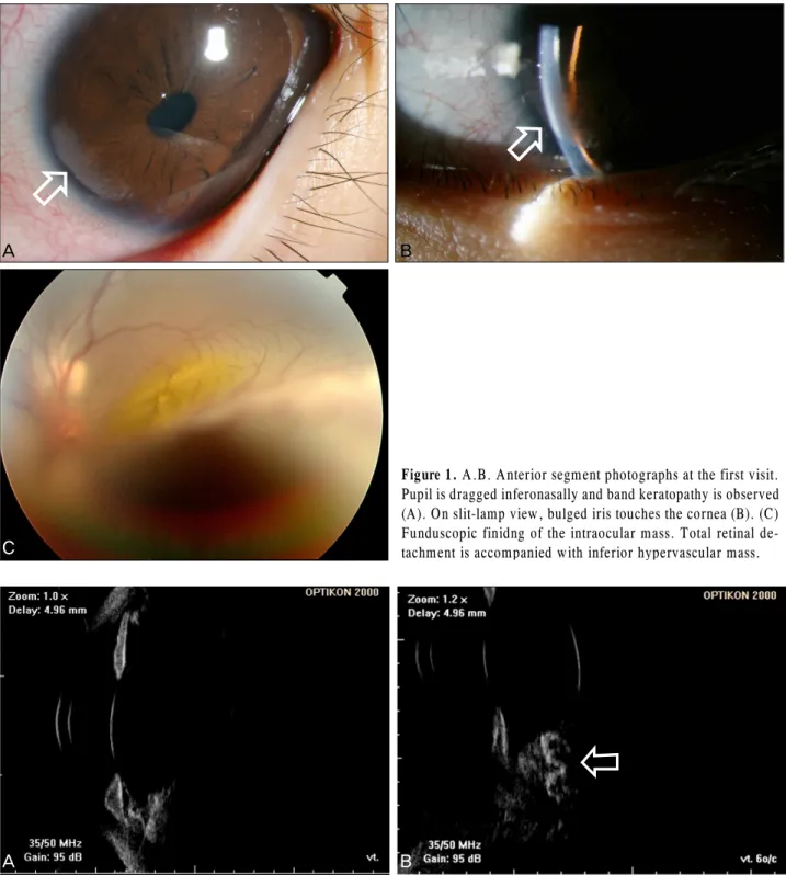 Figure 1. A.B. Anterior segment photographs at the first visit.  