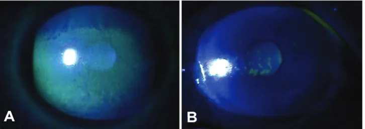 Figure  1. Slit  lamp  photographs  with  fluorescein  staining  in  GVHD  patient  with  dry  eye  syndrome  before  (A)  and 1  year  after  (B)  0.05%  cyclosporine  A  therapy