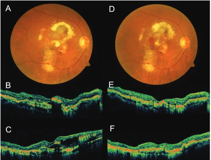 Figure  3. Case  No.  3  (A)  Baseline  fundus  photograph  shows  hard  exudates,  pigmentations  around  macula