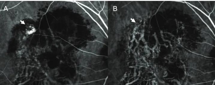 Figure 5. Case No. 6 (A) Baseline fundus photograph shows orange nodular lesion at temporal area from fovea