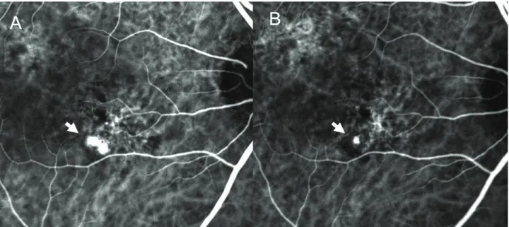 Figure  6. Case  No.  6  (A)  Baseline  ICGA  shows  polypoidal  dilatation  of  choroidal  vessels  and  branching  vascular  network