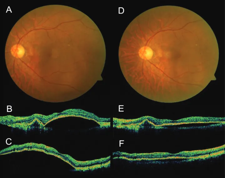Figure 8. Case No. 12 (A) Fundus photograph of seven month after the second injection