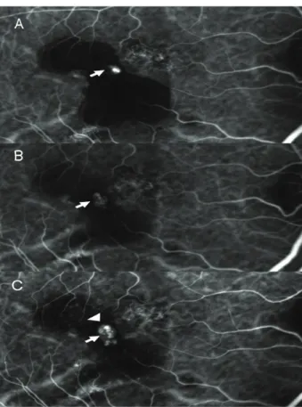 Figure  10. Case  No.  13  (A)  Baseline  fundus  photograph  shows  orange  nodular  lesion  around  macula