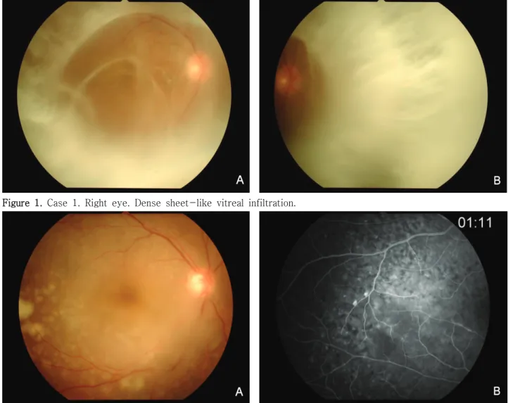 Figure  1. Case  1.  Right  eye.  Dense  sheet-like  vitreal  infiltration.
