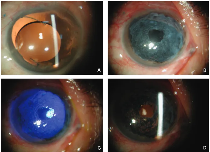 Figure 1. Photograph shows an eye having traumatic aniridia (A). We performed both corneal tattooing and amniotic  membrane transplantation with the central incision (B)