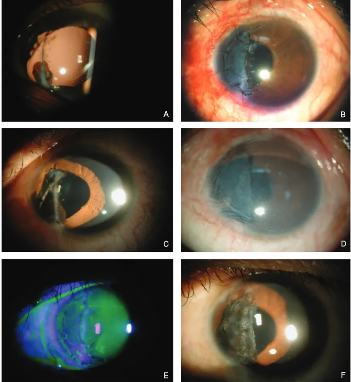 Figure  2. Photograph  shows  a  partial  iris  defect  on  the  6~10  o’clock  direction  (A)