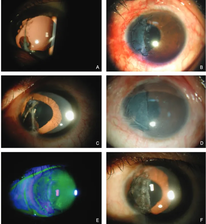 Figure  2. Photograph  shows  a  partial  iris  defect  on  the  6~10  o’clock  direction  (A)