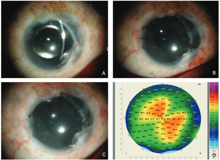 Figure 3. Photograph shows an eye having traumatic aniridia (A). We performed intrastromal corneal tattooing (B)