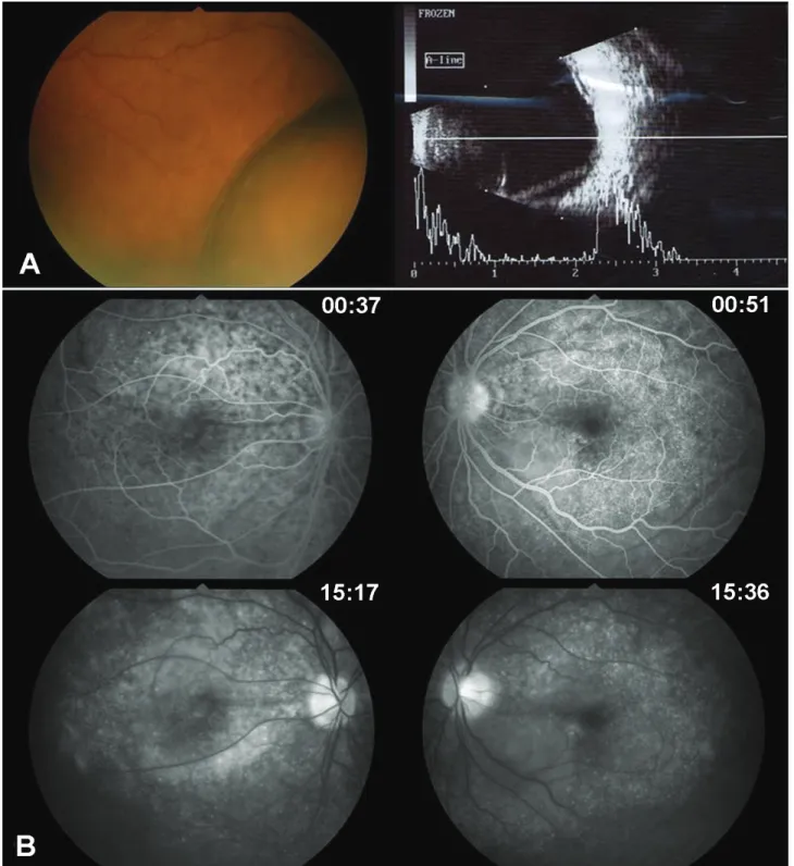 Figure  2. (Case  2)  (A)  Fundus  photograph  and  B-scan  show  smooth-elevated  choroidal  detachment