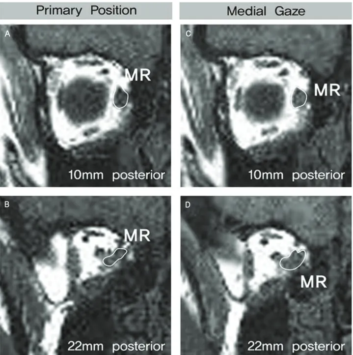 Figure 5. Quasi-coronal images of right orbit in primary position and medial gaze in a patient, who underwent medial  rectus  impingement  reduction  surgery  (postoperative  2  months)