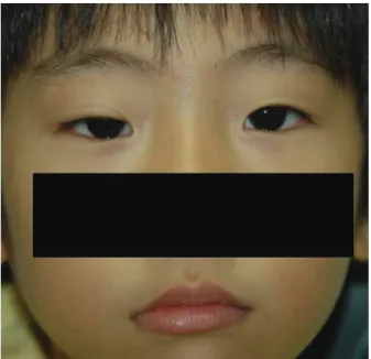 Figure  2. The  left  eyelid  was  retracted  by  2  mm,  when  the  patient  moves  the  jaw  to  the  right  side.