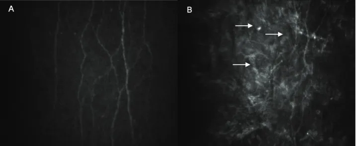Figure  1. Confocal  microscopic  images  of  the  subbasal  nerve  plexus  layer  of  the  cornea  in  the  control  (A)  and  corresponding post-PRK corneas (B)