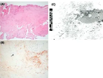 Figure  4. (A)  Light  microscope  shows  degenerative  fibrous  tissue  sclerosis.  (H  &amp;  E  stain)  (B)  Smooth  muscle  actin  positive