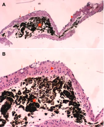 Figure 2. Microscopic examination of the excised tissue  shows  that  black  pigmented  lesion  is  a  stroma  of  the  iris  (red  star)  is  surrounded  by  stratified  epithelium  (red  arrow  head)  contains  conjunctival  origin  goblet  cells  (red  