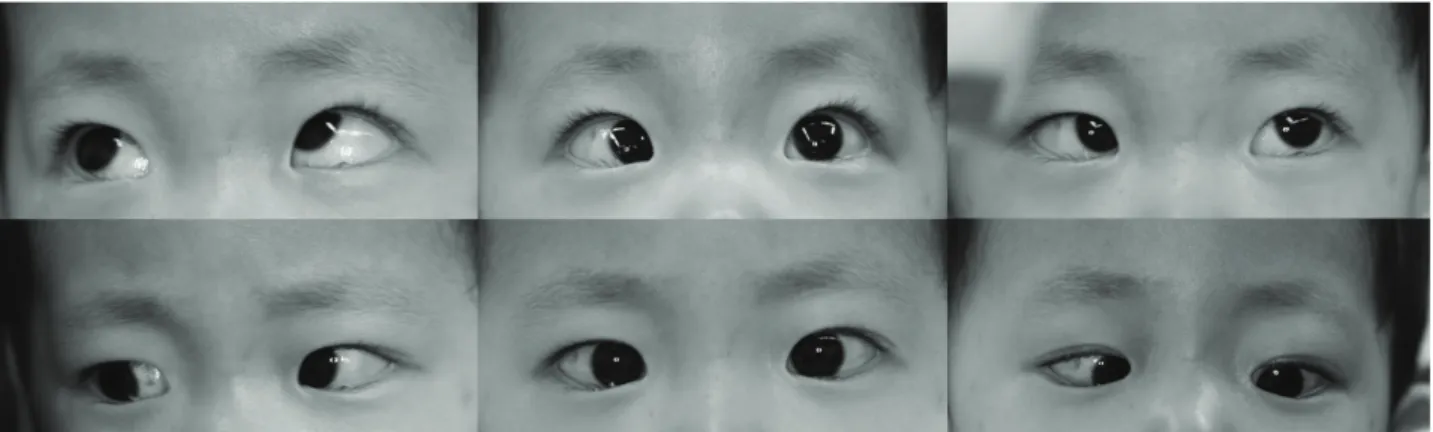 Figure  1.  Photographs  showing  esotropia  and  inferior  oblique  overaction  in  the  left  eye