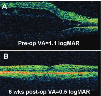 Figure 2. Typical optical coherence tomography (OCT)  appearance  in  a  case  treated  with  PPV