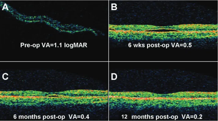 Figure 3. Typical optical coherence tomography (OCT) appearance in a case treated with buckling