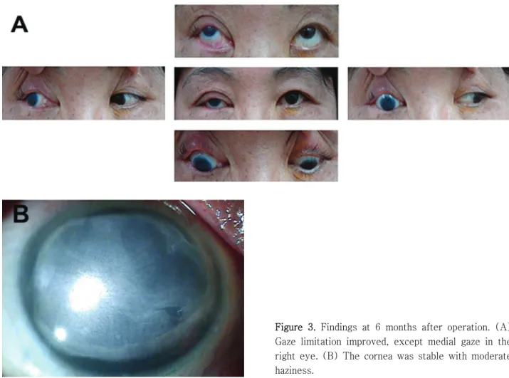 Figure  3.  Findings  at  6  months  after  operation.  (A)  Gaze  limitation  improved,  except  medial  gaze  in  the  right  eye