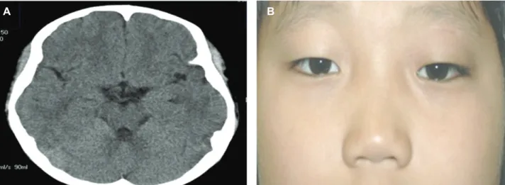 Figure  3. (A)  Complete  disappearance  of  subdural  abscess  in  brain  CT  4  months  after  orbital  cellulitis
