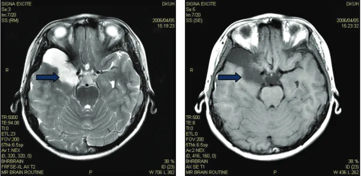 Figure  3. The  patient’s  transverse  brain  MRI  section  shows  arachnoid  cyst  in  the  right  temporal  lobe.