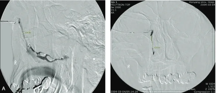 Figure  1. Digital  subtraction  dacryocystograph.  (A,  lateral  view;  B,  anteroposterior  view)
