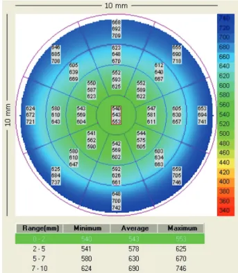 Figure 2. Optical coherence tomography (Visante OCT) cross-sectional view through the anterior chamber angle region