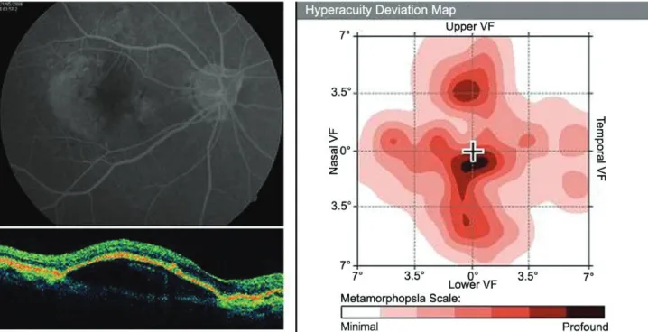 Figure 1. Positive correlation between pigment epithelial detachment length and preferential hyperacuity perimeter defect  size  (Pearson’s  r=0.496,  p=0.010).