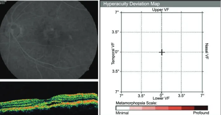 Figure  4. Preferential  hyperacuity  perimeter  height  is  significantly  higher  in  the  postive  hyperacuity  defect  group  than  in  the  negative  group  (p=0.000).
