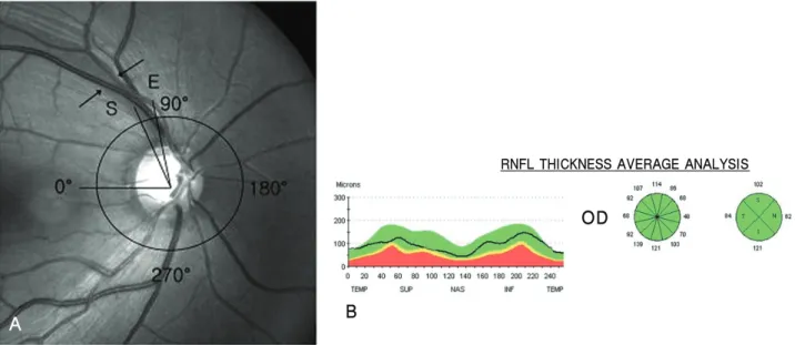 Figure 1. False negative findings of OCT and measurement of the location and width of RNFL defect on red-free fundus photograph
