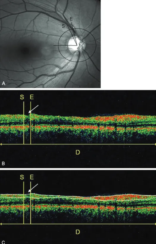 Figure  2. Analysis  of  causes  about  false  negative  response  of  OCT.  (A)  Localized  RNFL  defect  was  detected  on  red-free fundus photograph