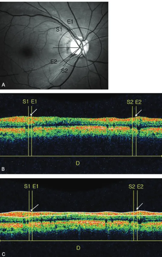 Figure 3. Analysis of causes about false negativeness of OCT. (A) Two localized RNFL defects were detected on  red-free fundus photograph