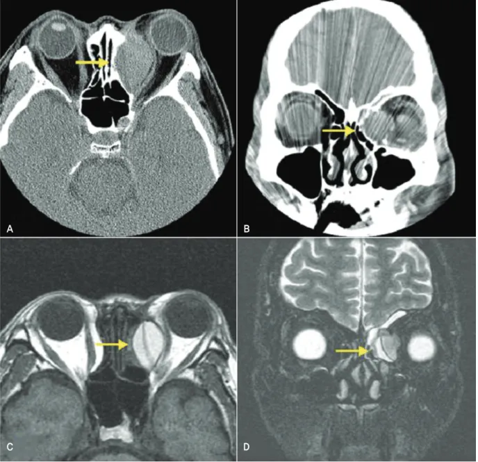 Figure  2. Axial  (A)  and  coronal  (B)  orbit  CT  scans  show  a  large  cystic  mass  adjacent  to  the  medial  wall  of the orbit