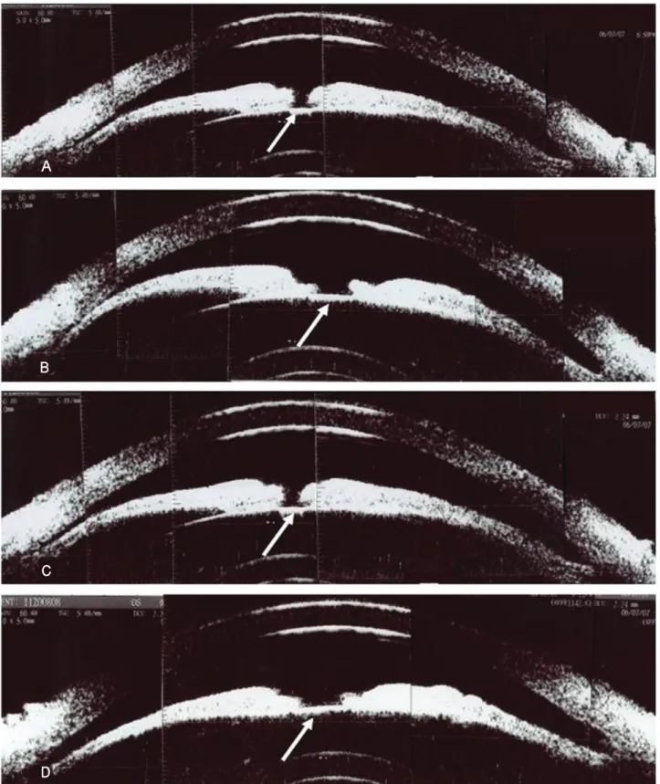 Figure  3. A  ultrasound  biomicroscopy  (UBM)  of  both  the  eyes  shows  shallow  anterior  chamber,  convex  iris,  and  constricted pupil