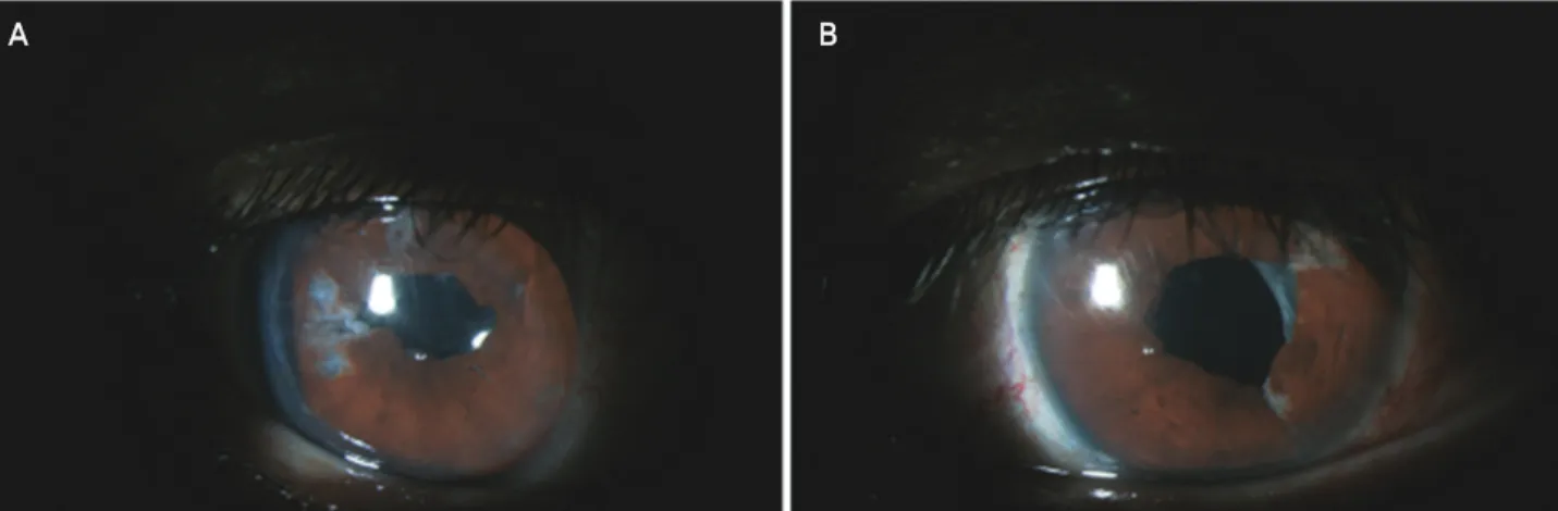 Figure  4. Postoperative  anterior  segment  photograph  of  congenital  microcoria.  (A)  Mid-dilated  irregular-shaped  pupil  of  the  right  eye  is  seen  due  to  iris  sphincter  rupture  and  iris  injury