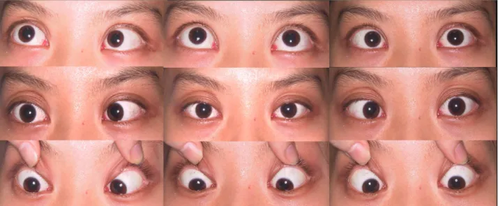 Figure 1. On the 3rd day of hospitalization, both pupils were dilated and ocular motor examination revealed bilateral  complete  limitation  of  abduction  and  supraduction  and  mild  limitation  of  adduction.