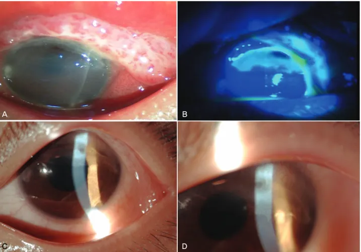 Figure 1. Right eye of case 1 (1st visit). Mild conjunc- conjunc-tival hyperemia and corneal epithelial defect (diameter< 