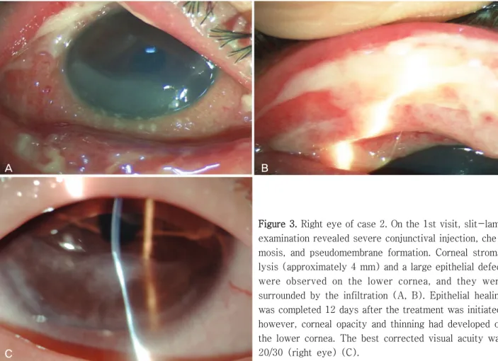 Figure 3. Right eye of case 2. On the 1st visit, slit-lamp  examination revealed severe conjunctival injection,  che-mosis,  and  pseudomembrane  formation